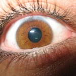 Reflexiones sobre el Glaucoma (II)