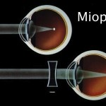 Doctor, tengo glaucoma y miopía: ¿Me puedo operar?