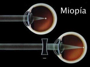 ¿Puedes operarte de Miopía si tienes Glaucoma?