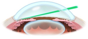 Tratamiento del Glaucoma con Selective Laser Trabeculoplasty