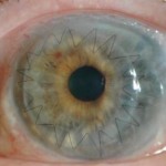 El Glaucoma y el transplante de córnea: Lo que es bueno para uno…
