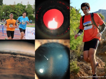 El Glaucoma Pigmentario y el deporte (Running, Baloncesto, Tenis, .....)