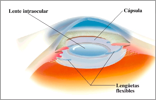 Implantación de las lentes intraoculares