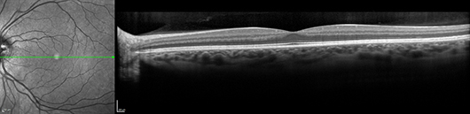 NormalMaculaOCT tomado de HeidelbergEngineering