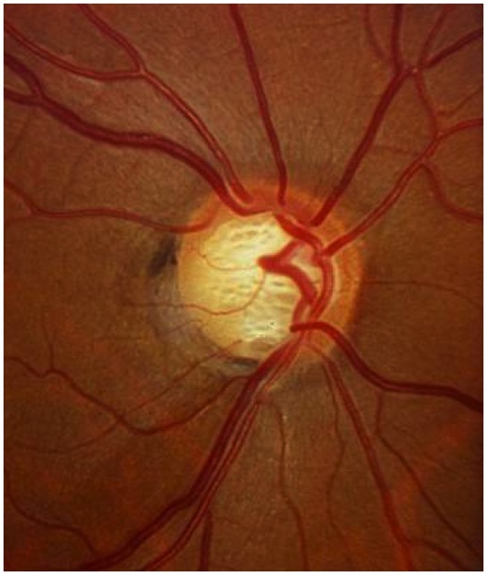 Qué es el Glaucoma - Especialista en Glaucoma